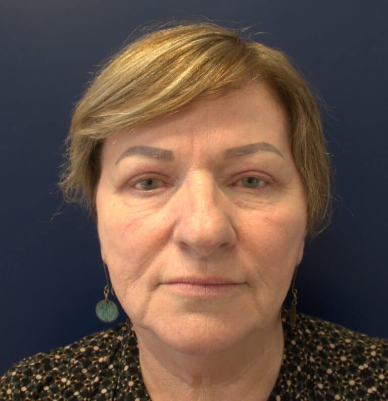 After Image: Upper Blepharoplasty - front
