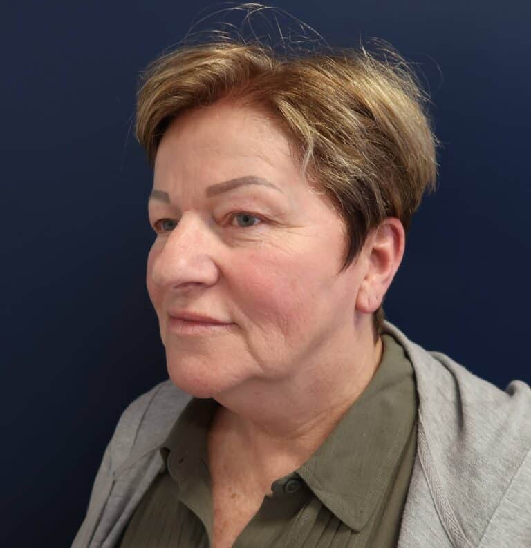 Before Image: Upper Blepharoplasty - right-side